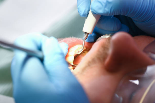 Best Emergency Dental Extractions in Kingstowne, VA