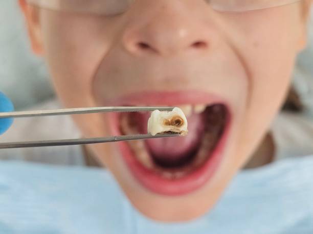 Best Emergency Root Canal Treatment in Kingstowne, VA